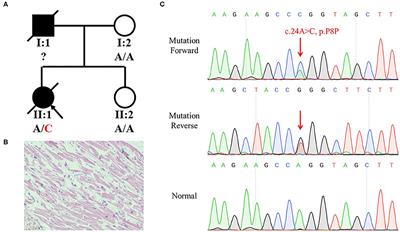 Case Report: Identification of the First Synonymous Variant of Myosin Binding Protein C3 (c.24A>C, p.P8P) Altering RNA Splicing in a Cardiomyopathy and Sudden Cardiac Death Case